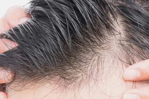 Unshaved-Hair-Transplant_2026