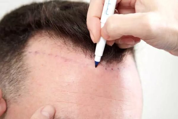 fue-hairtransplant