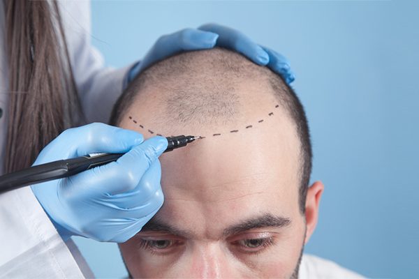 hair-transplant
