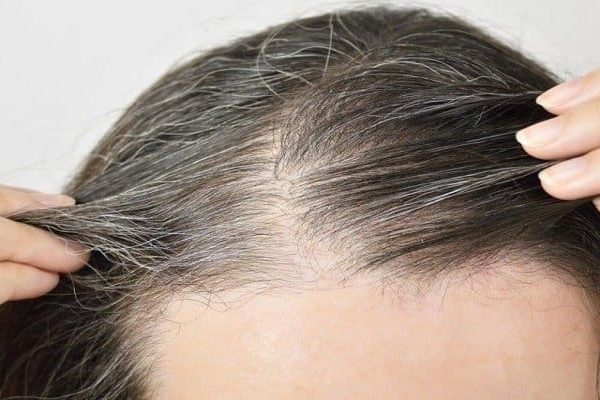 hairtransplantation for women