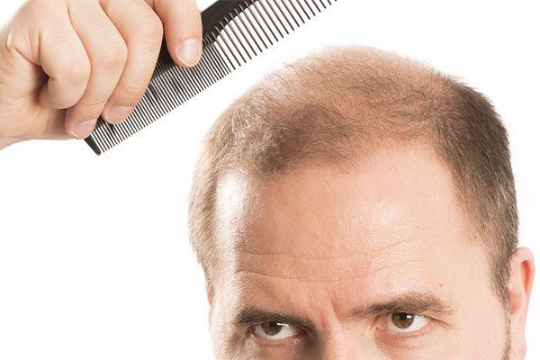 dhi-hair-transplant