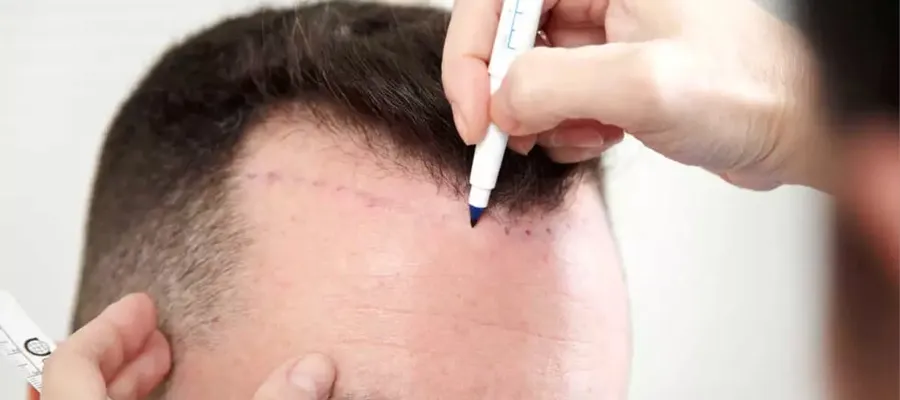 fue-hairtransplant_2026