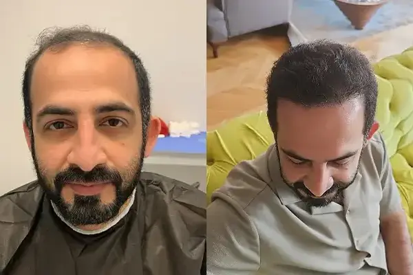 Hair-Transplant-Training-2-622x400