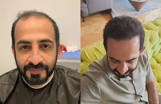 Hair-Transplant-Training-2-622x400