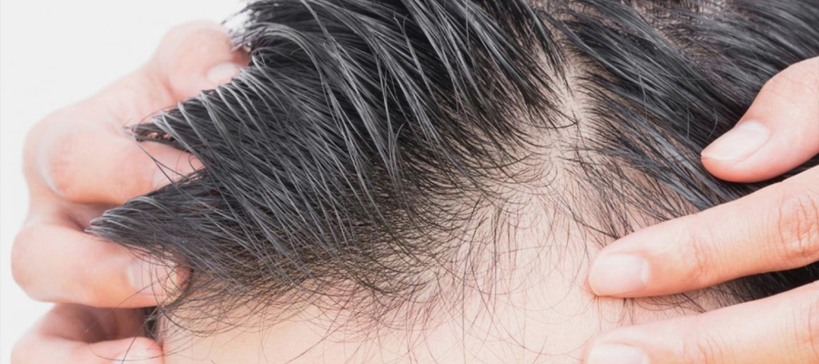 Unshaved Hair Transplant