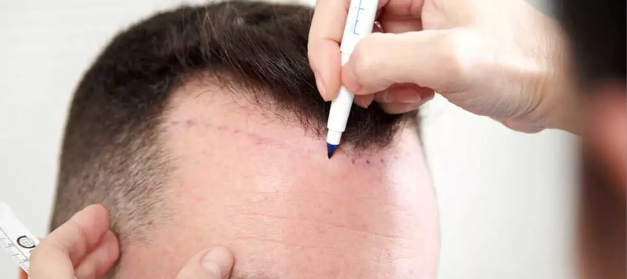 fue-hairtransplant