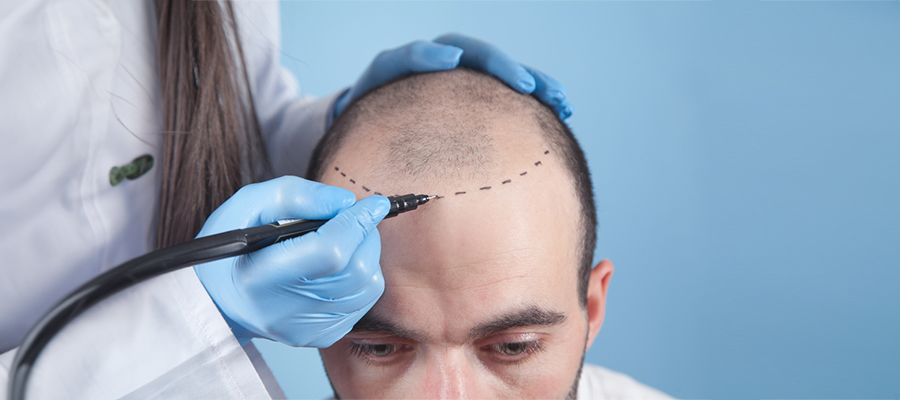 hair-transplant