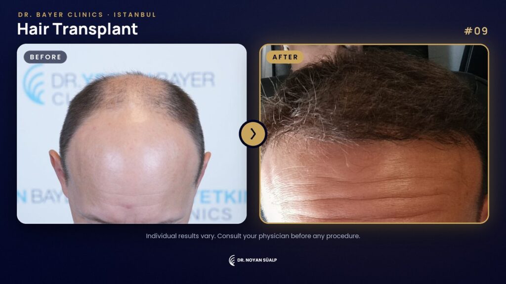 Hair transplant before and after by Dr. Noyan Süalp, case 09, Dr. Bayer Clinics Istanbul