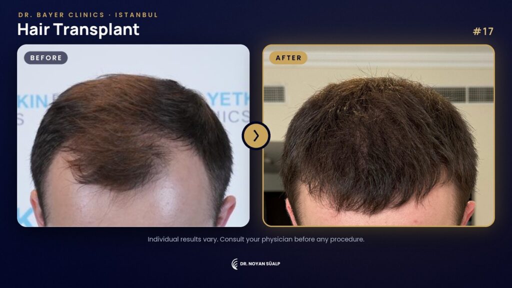 Hair transplant before and after by Dr. Noyan Süalp, case 17, Dr. Bayer Clinics Istanbul