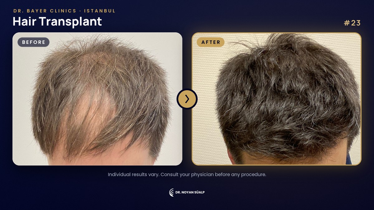 Hair transplant before and after by Dr. Noyan Süalp, case 23, Dr. Bayer Clinics Istanbul