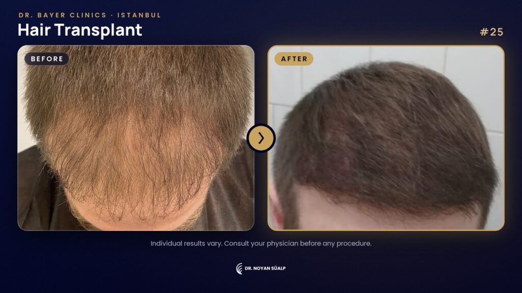 Hair transplant before and after by Dr. Noyan Süalp, case 25, Dr. Bayer Clinics Istanbul