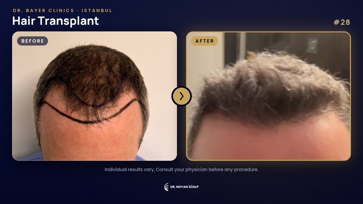 Hair transplant before and after by Dr. Noyan Süalp, case 28, Dr. Bayer Clinics Istanbul