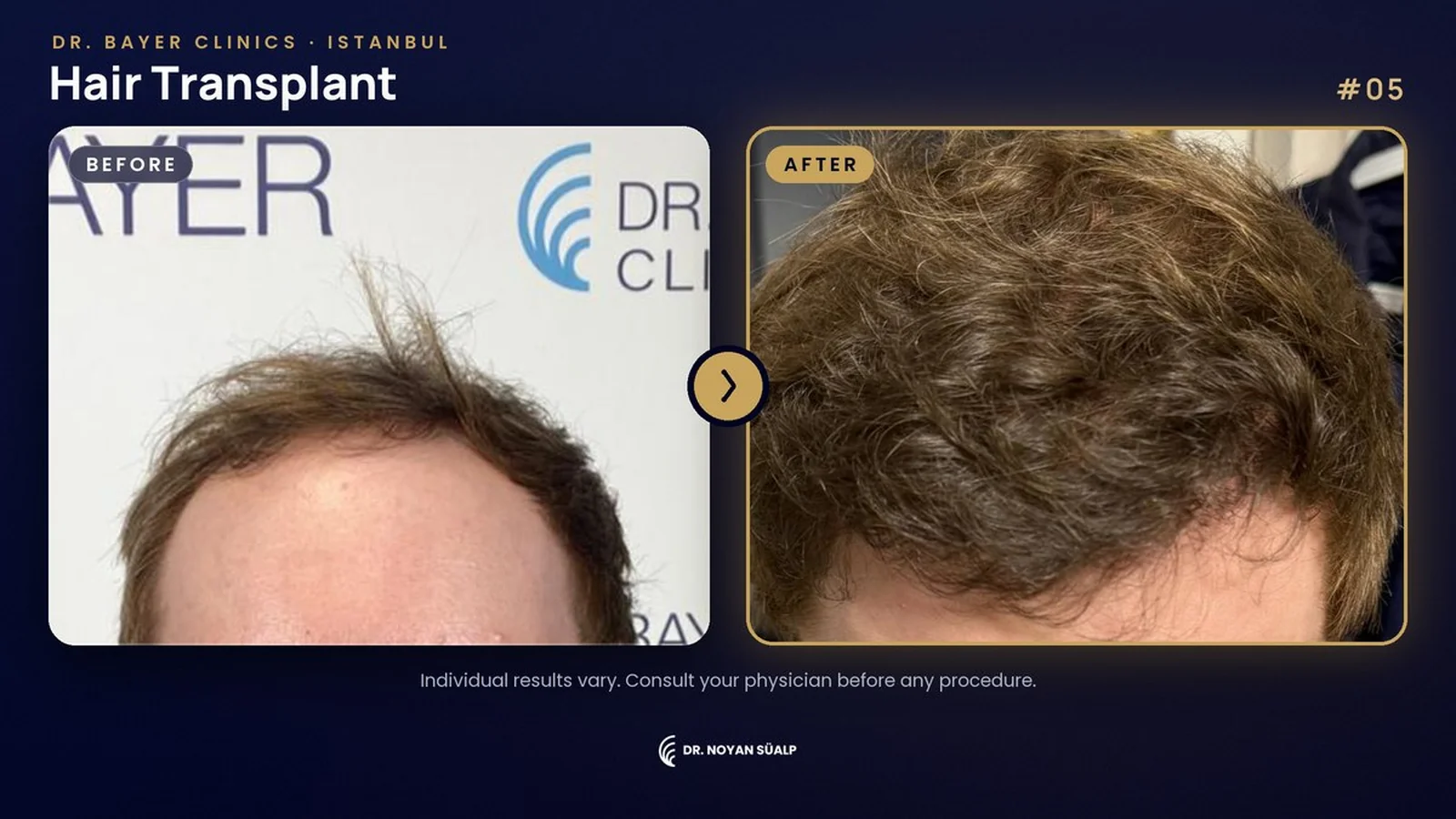 Hair transplant before and after by Dr. Noyan Süalp, case 05, frontal hairline, Dr. Bayer Clinics Istanbul