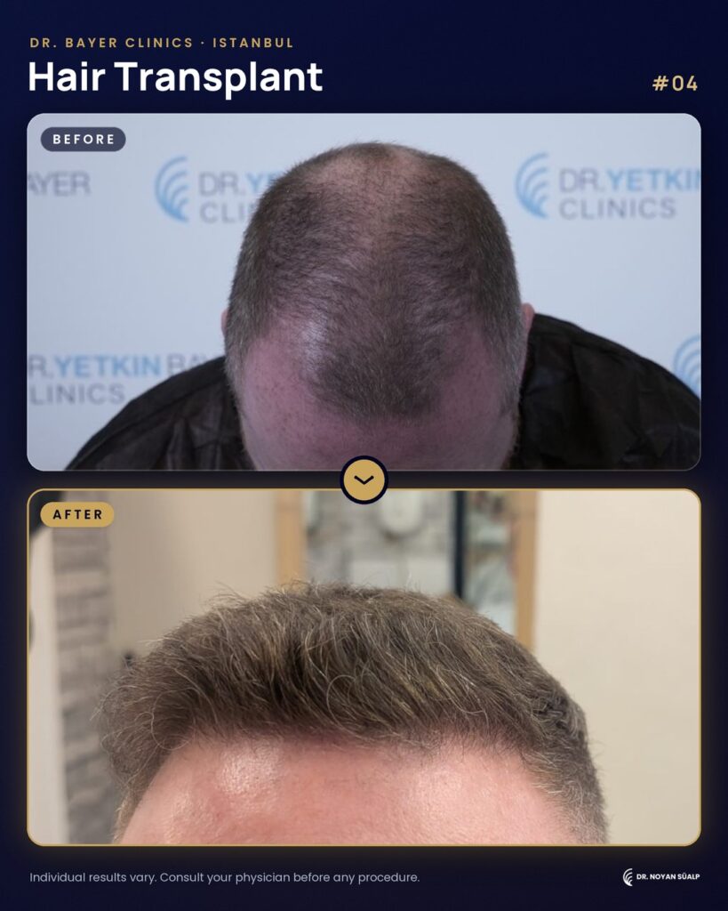 Hair transplant before and after by Dr. Noyan Süalp, case 04