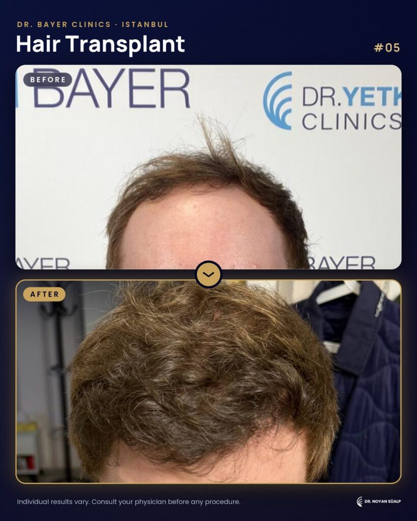 Hair transplant before and after by Dr. Noyan Süalp, case 05