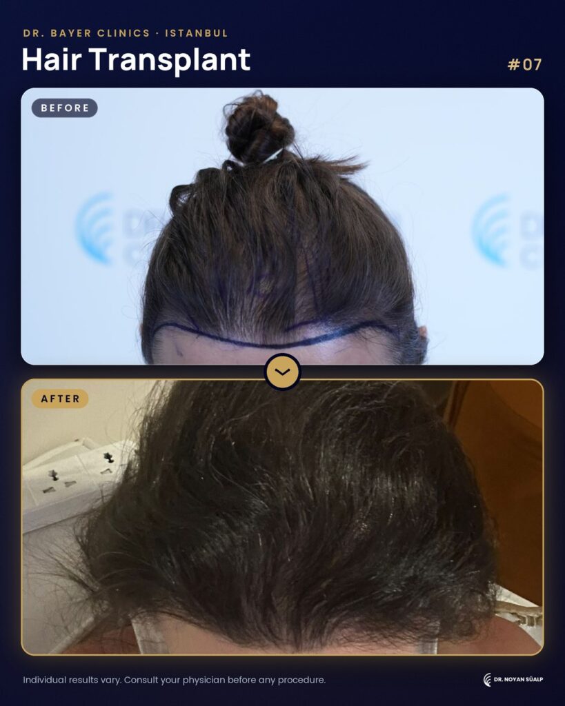 Hair transplant before and after by Dr. Noyan Süalp, case 07