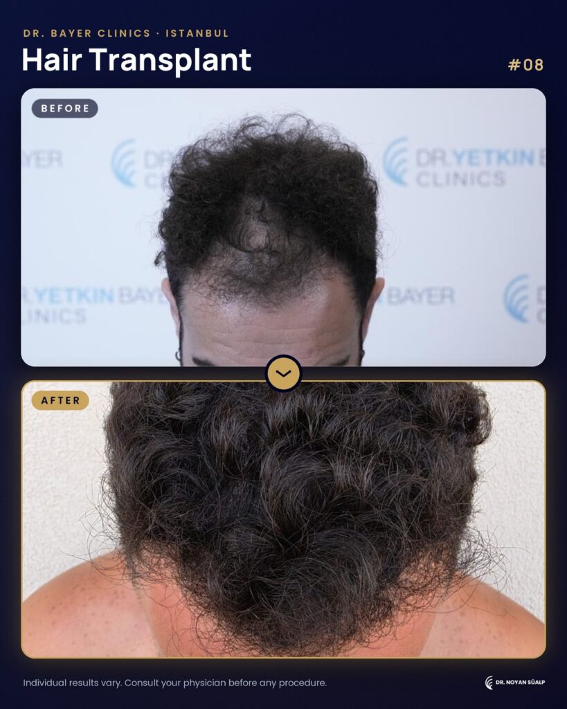 Hair transplant before and after by Dr. Noyan Süalp, case 08