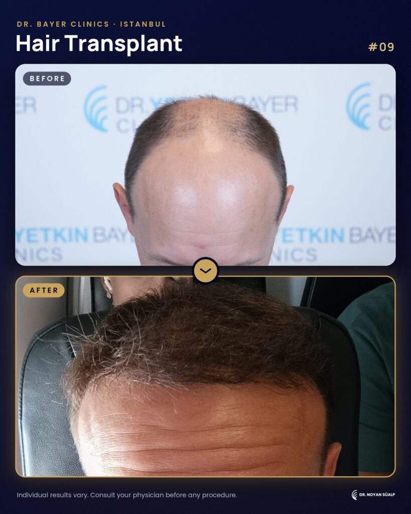 Hair transplant before and after by Dr. Noyan Süalp, case 09