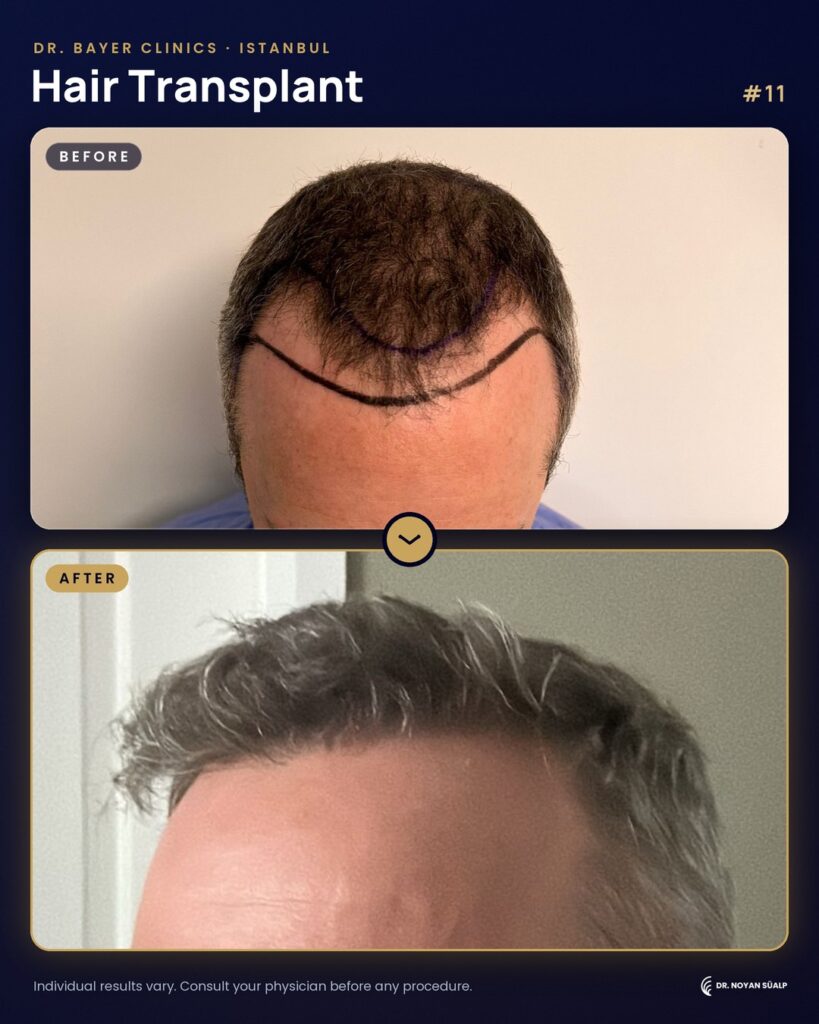 Hair transplant before and after by Dr. Noyan Süalp, case 11