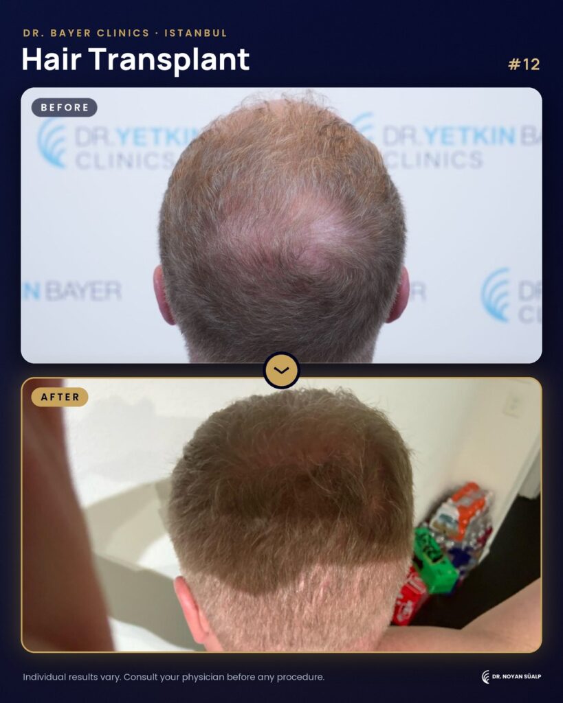 Hair transplant before and after by Dr. Noyan Süalp, case 12