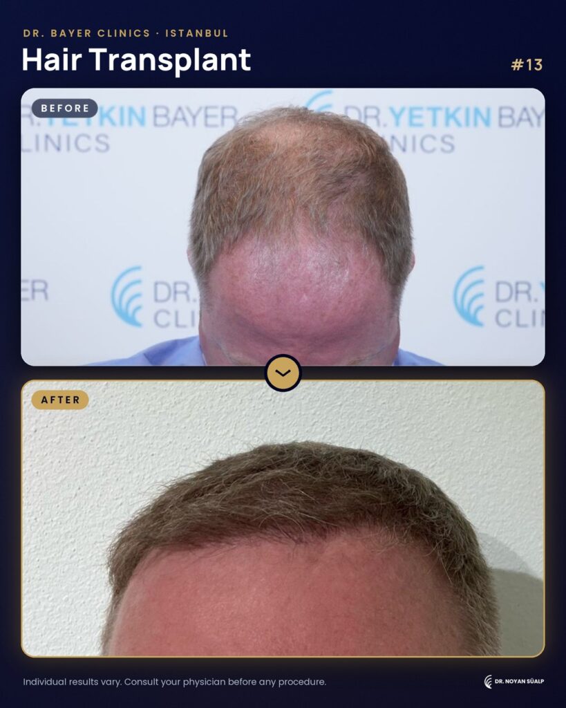 Hair transplant before and after by Dr. Noyan Süalp, case 13
