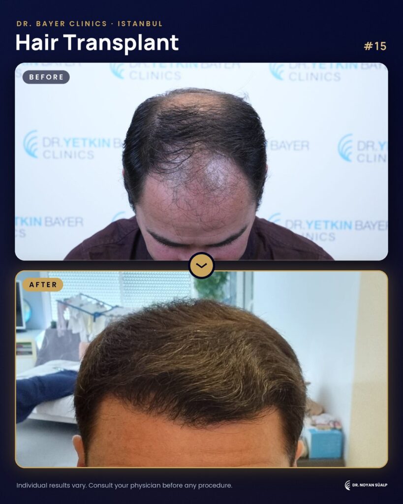 Hair transplant before and after by Dr. Noyan Süalp, case 15
