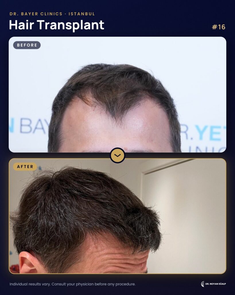 Hair transplant before and after by Dr. Noyan Süalp, case 16