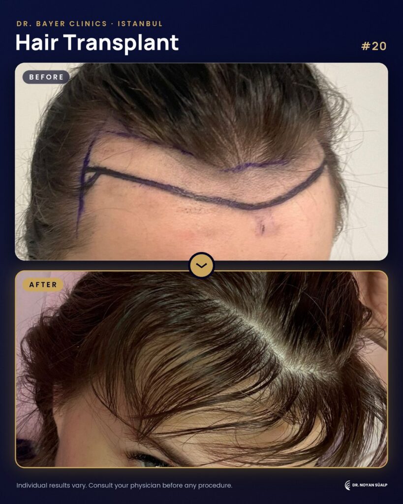 Hair transplant before and after by Dr. Noyan Süalp, case 20