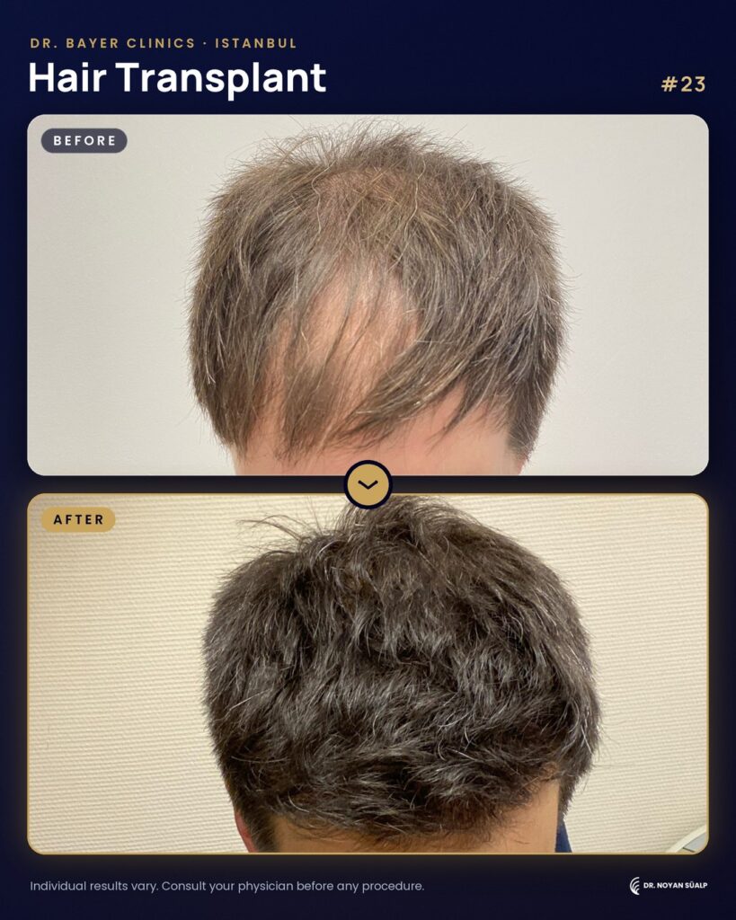 Hair transplant before and after by Dr. Noyan Süalp, case 23