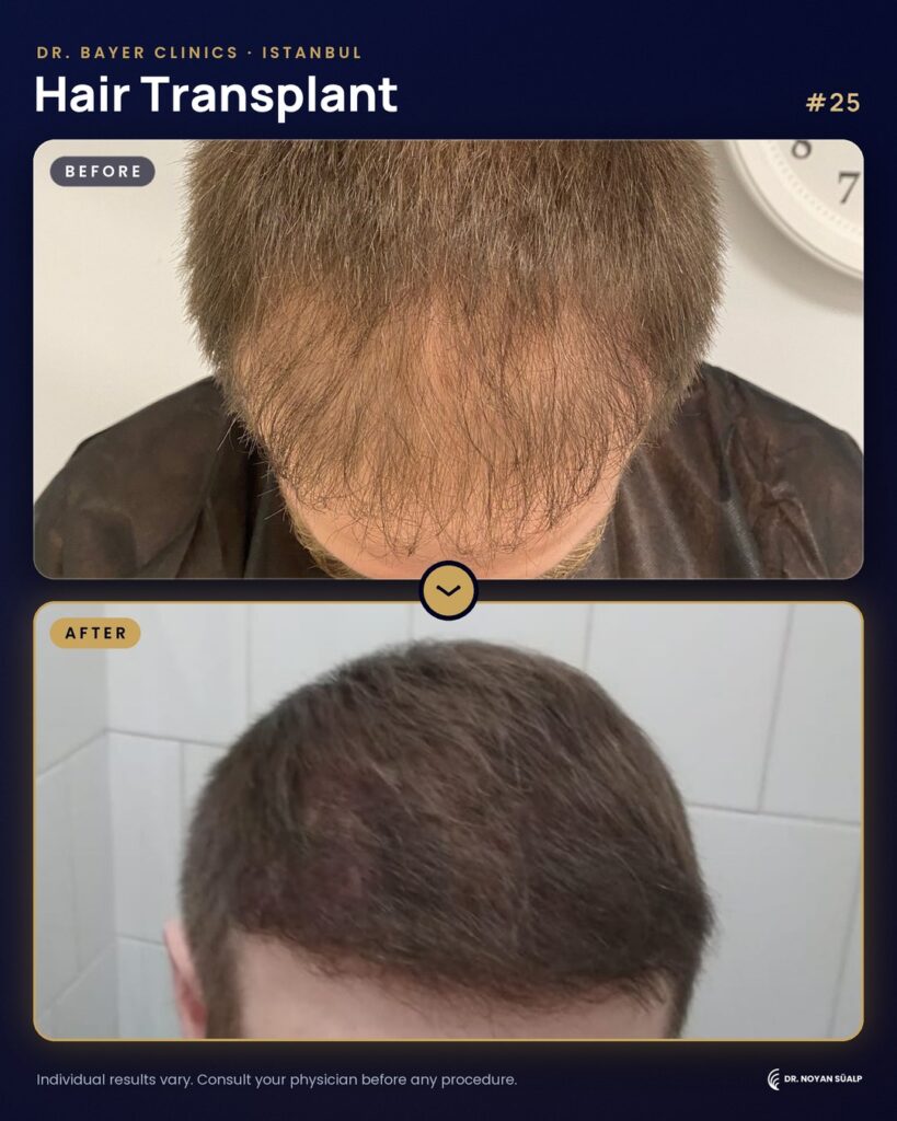Hair transplant before and after by Dr. Noyan Süalp, case 25