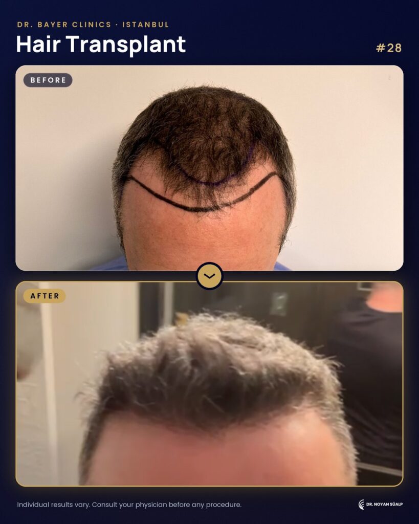 Hair transplant before and after by Dr. Noyan Süalp, case 28