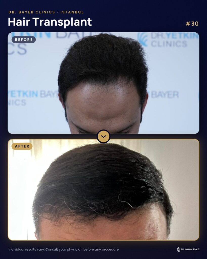 Hair transplant before and after by Dr. Noyan Süalp, case 30