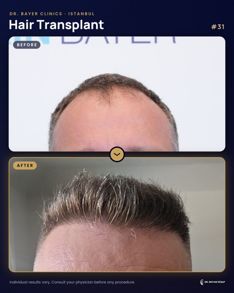 Hair transplant before and after by Dr. Noyan Süalp, case 31
