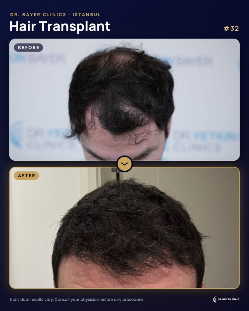 Hair transplant before and after by Dr. Noyan Süalp, case 32
