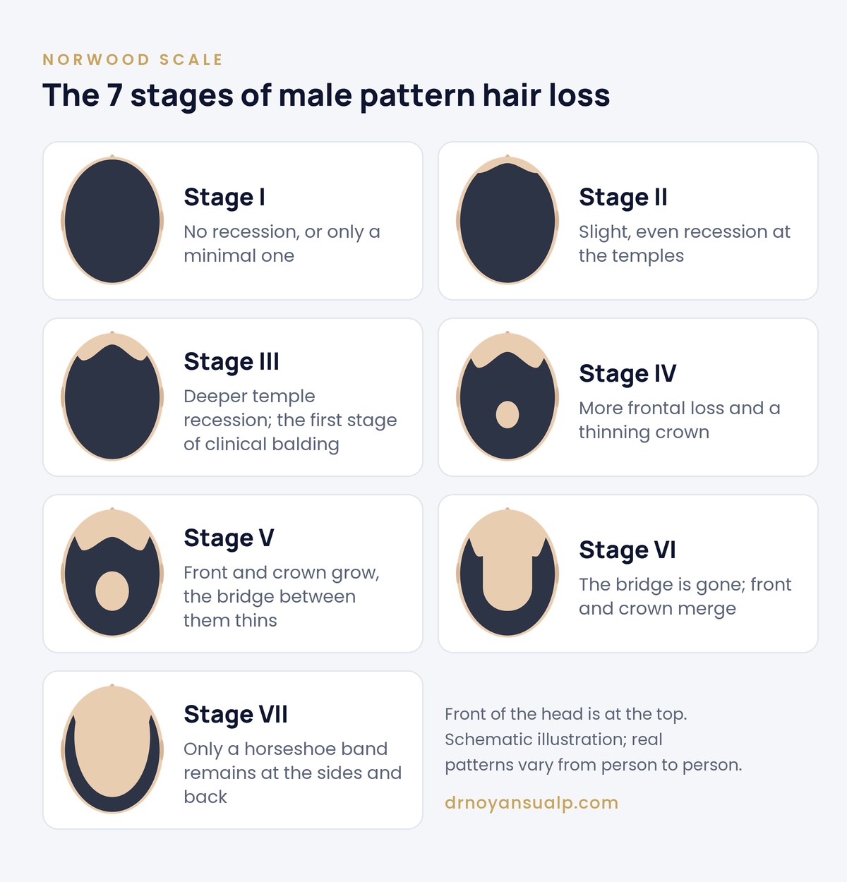 Norwood scale stages I to VII with a short description of each stage