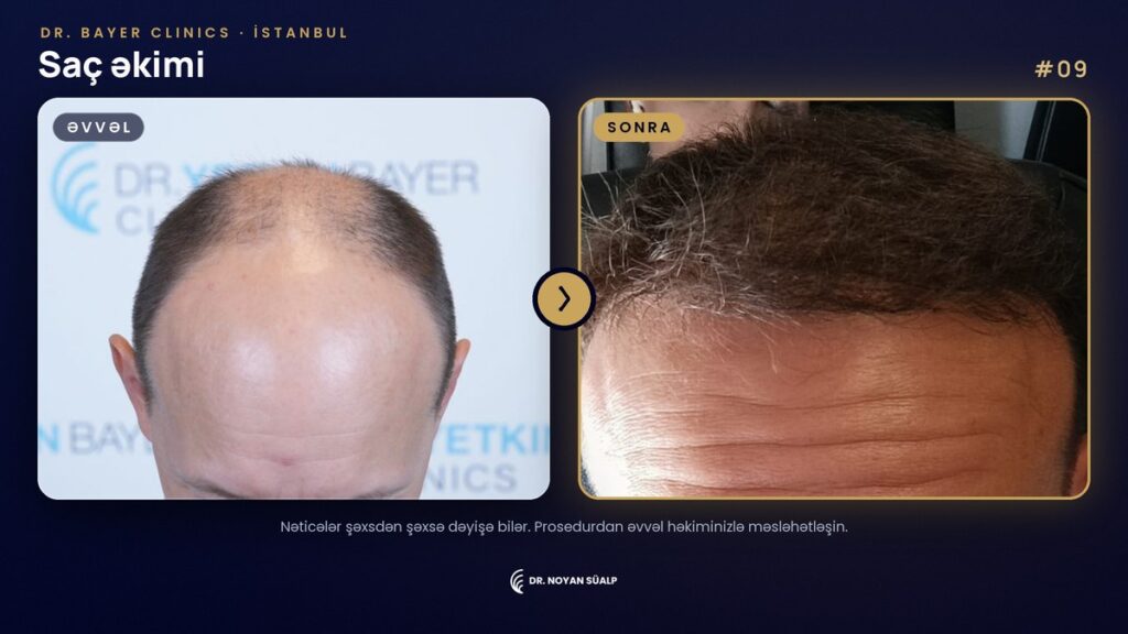 Dr. Noyan Süalp: saç əkimindən əvvəl və sonra, 09 nömrəli nümunə, Dr. Bayer Clinics İstanbul