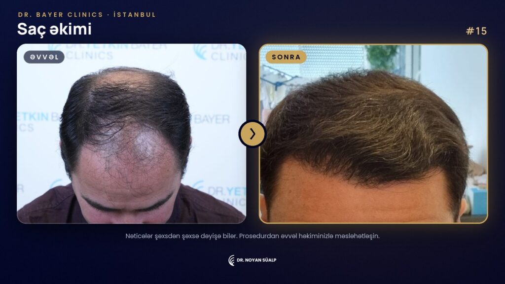 Dr. Noyan Süalp: saç əkimindən əvvəl və sonra, 15 nömrəli nümunə, Dr. Bayer Clinics İstanbul
