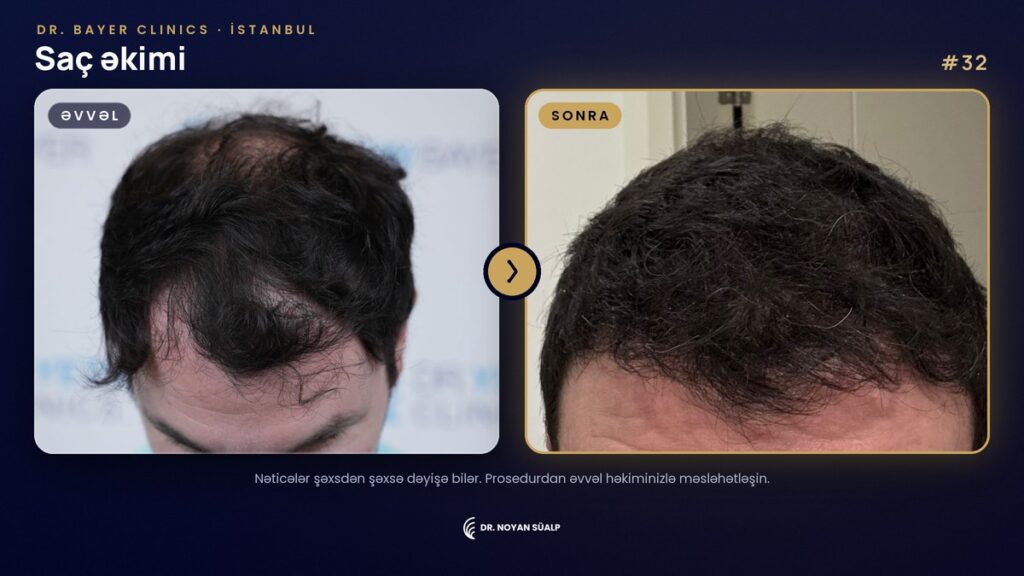 Dr. Noyan Süalp: saç əkimindən əvvəl və sonra, 32 nömrəli nümunə, Dr. Bayer Clinics İstanbul