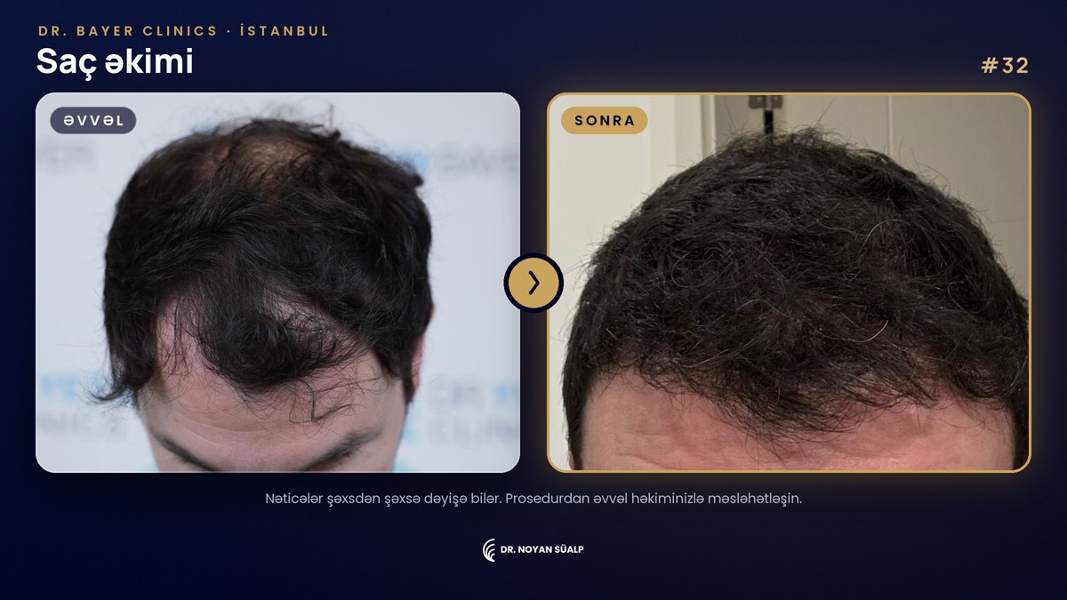 Dr. Noyan Süalp: saç əkimindən əvvəl və sonra, 32 nömrəli nümunə, Dr. Bayer Clinics İstanbul
